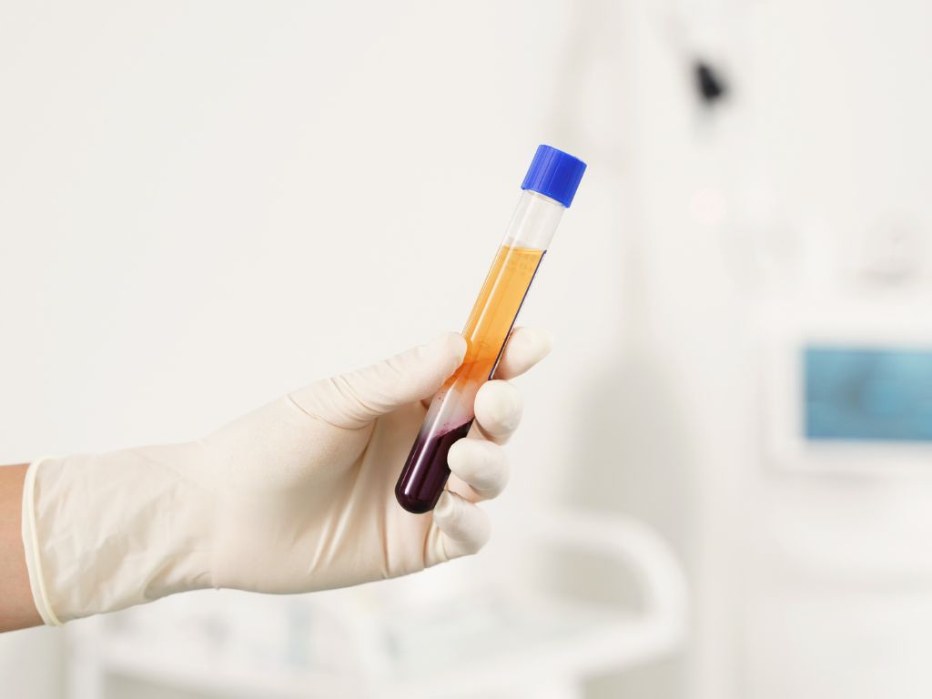 Platelet-Rich Plasma
